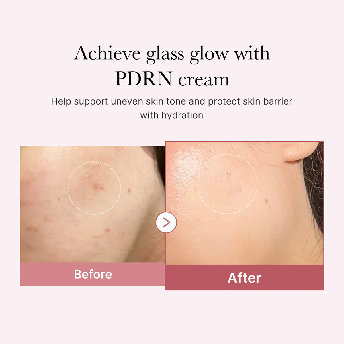 Before and after comparison of skin with PDRN cream application on a light pink background.