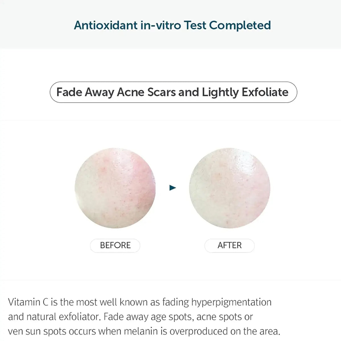 Before and after comparison of acne scars with text about antioxidant test and vitamin C benefits.