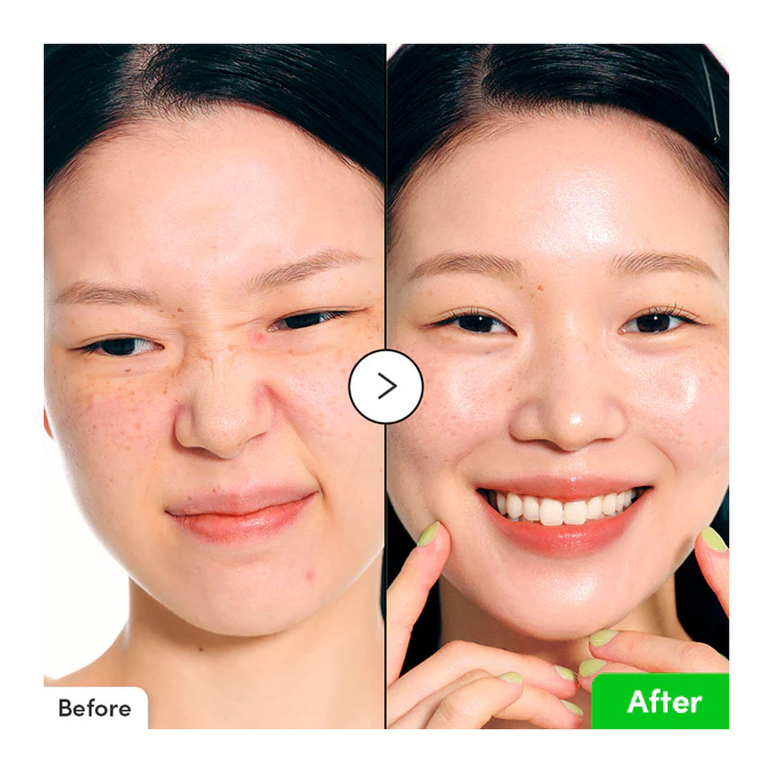 Before and after comparison of a person's face with visible skin improvement.