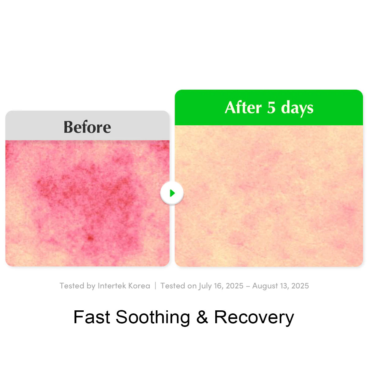 Before and after comparison of skin condition with text indicating recovery after 5 days.