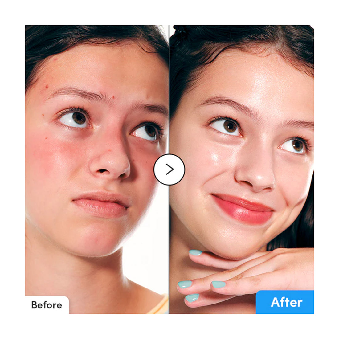 Before and after comparison of a person's face with visible skin improvement.
