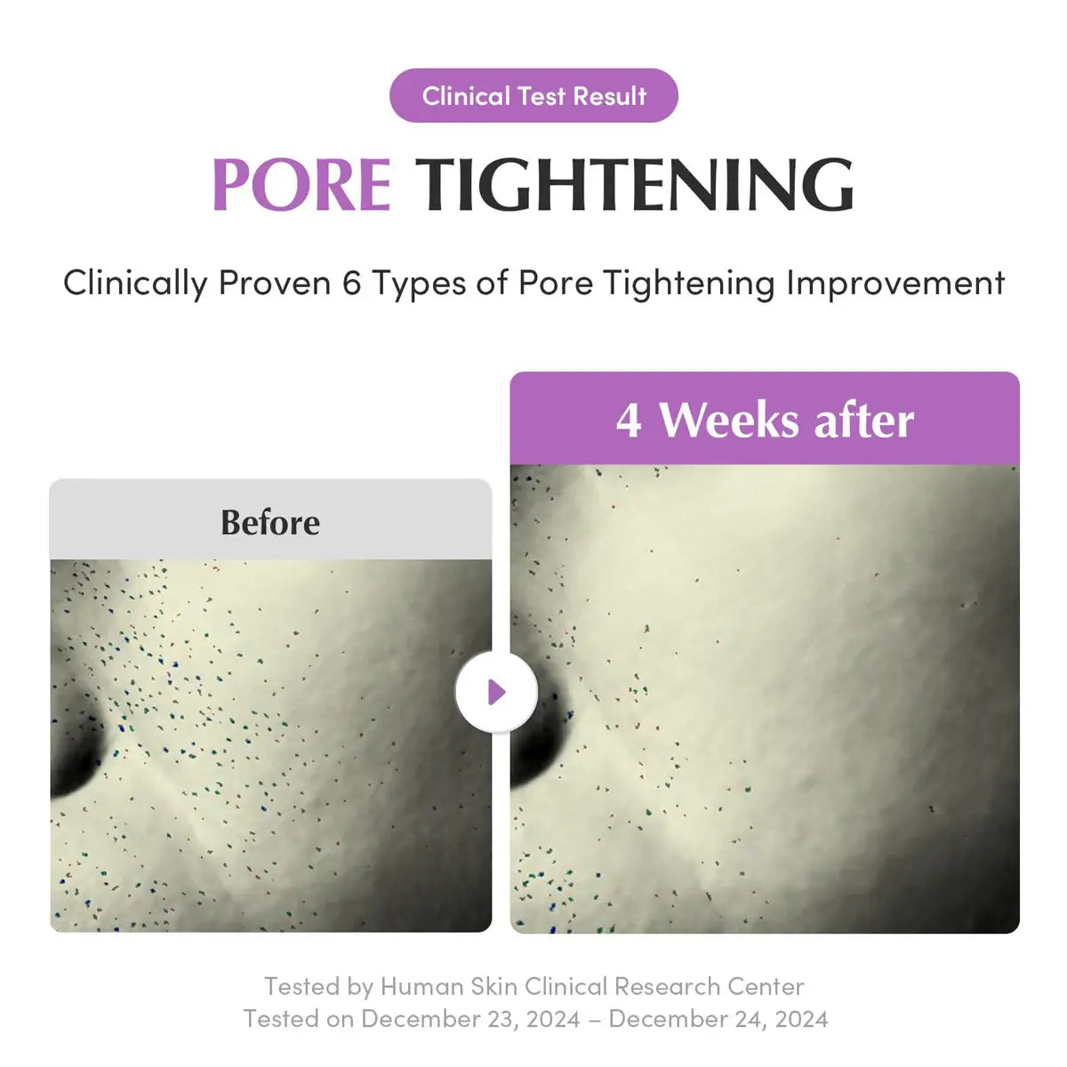Before and after comparison of pore tightening treatment with clinical test result and improvement types.