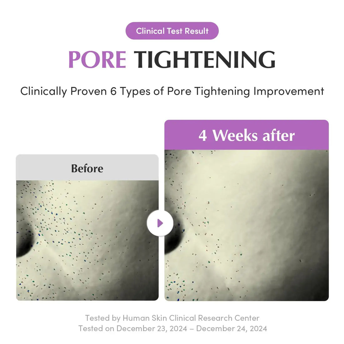 Before and after comparison of pore tightening treatment with clinical test result and improvement types.